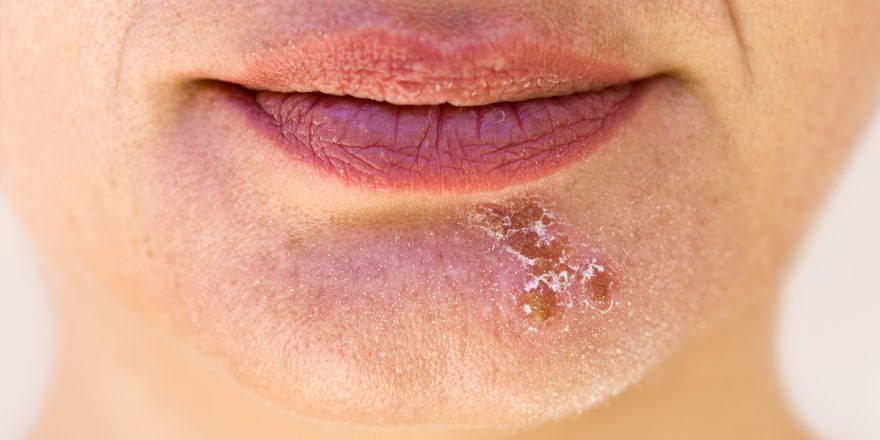 Cold Sores
