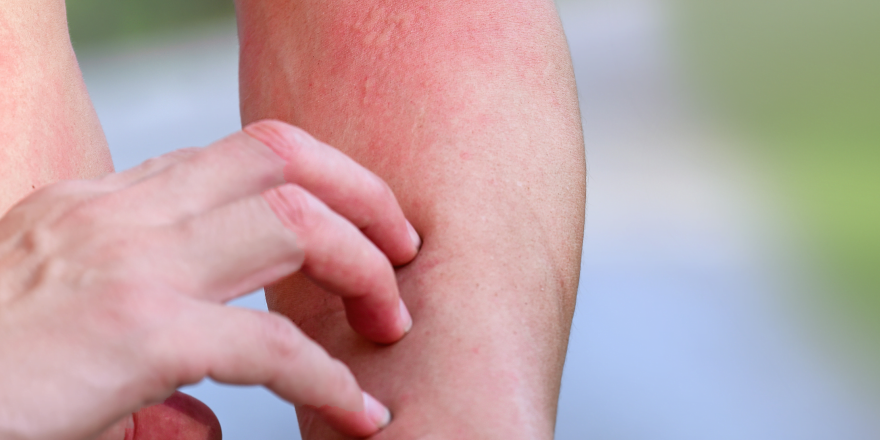 Scabies