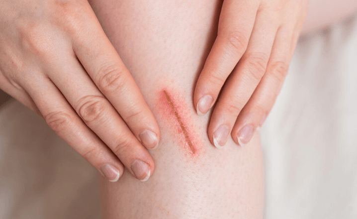 Handy Tips for supporting minor bumps, bruises and injuries