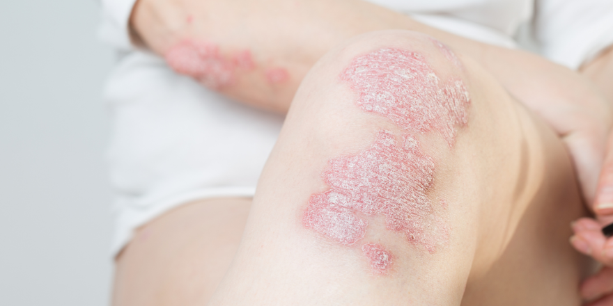 Psoriasis